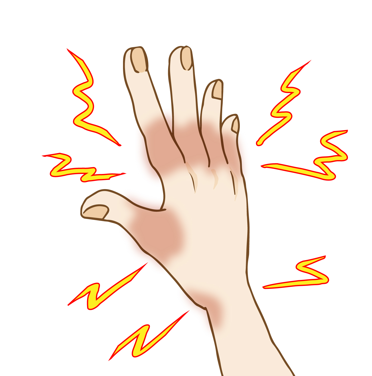 胸郭出口症候群は姿勢が原因？川崎の接骨院が根本改善 画像