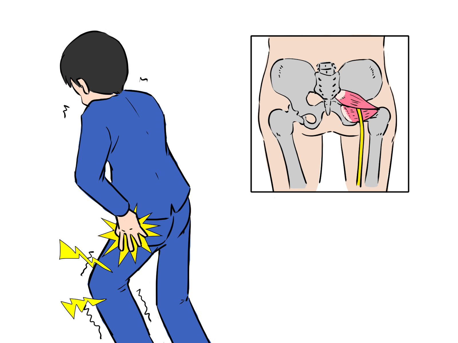 お尻から足にかけて違和感が走る…それ梨状筋症候群の可能性があります 画像